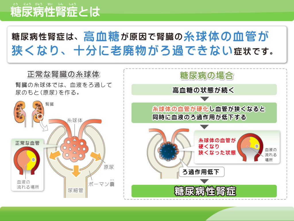 【画像】糖尿病性腎症